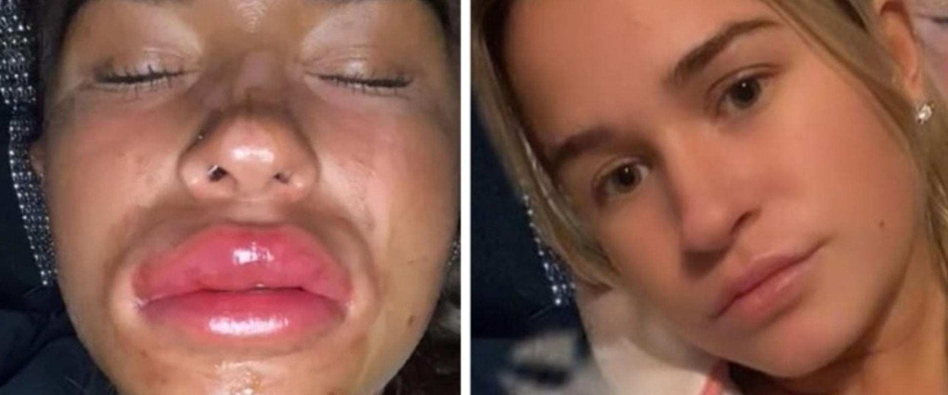Why Lip Fillers Reddit A Comprehensive Guide why-lip-fillers-reddit-a-comprehensive-guide