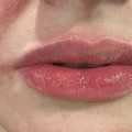Premium Lip fillers from Medical Weight Loss and Beauty