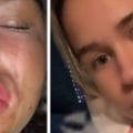 Why Lip Fillers Reddit? A Comprehensive Guide