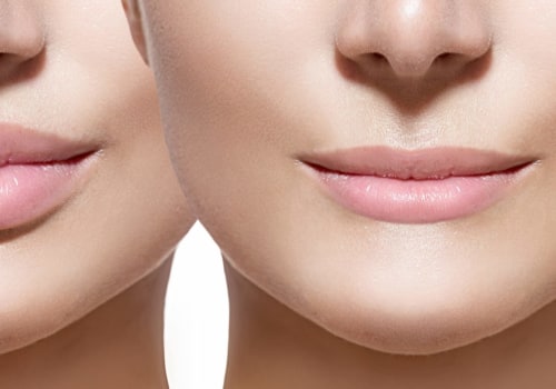 Are Lip Fillers Safe? A Comprehensive Guide