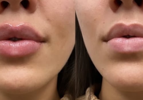 Who Can Do Lip Fillers? Expert Advice on the Procedure