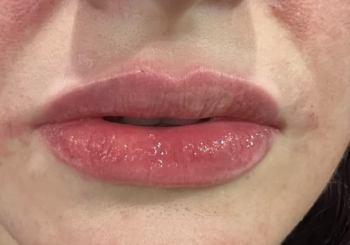 Premium Lip fillers from Medical Weight Loss and Beauty