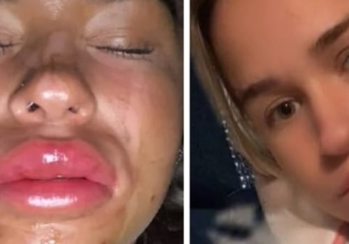 Why Lip Fillers Reddit? A Comprehensive Guide